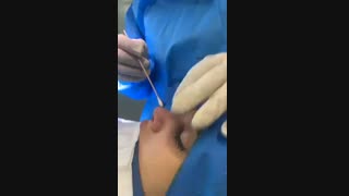 فیلم جراحی بینی گوشتی