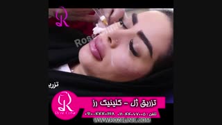 فیلم تزریق ژل | کلینیک رز | 09104440228 | شماره 179