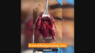 فیلم عمل ترمیمی بینی توسط دکتر باستانی نژاد | جراح بینی