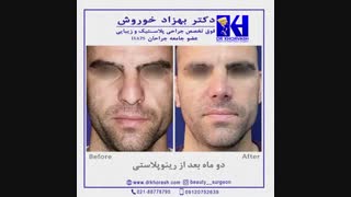 نتیجه رینوپلاستی بعد از دو ماه