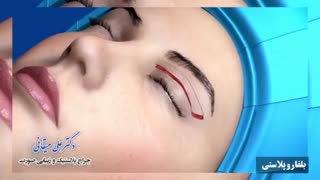 انیمیشن بلفاروپلاستی