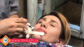 تزریق یک سی سی ژل لب | دکتر گلی