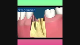 انیمیشین مراحل درمانی کانال ریشه