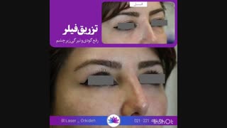 تزریق فیلر زیر چشم در کلینیک ارکیده