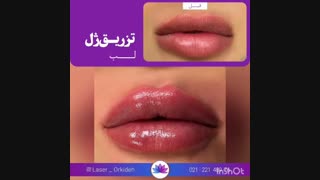 تزریق ژل لب در کلینیک ارکیده
