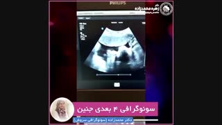 سونوگرافی 4 بعدی جنین