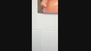 جراحی بینی حین عمل
