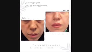 تزریق فیلر زیر چشم