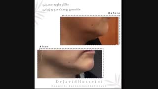 بهبود قابل ملاحظه غبغب و خط فکی با هایفوتراپی