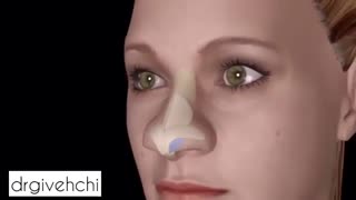 نحوه ی جراحی بینی گوشتی