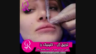 فیلم تزریق ژل | کلینیک رز | 09104440228 | شماره 184
