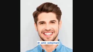 بهترین روش کاشت مو