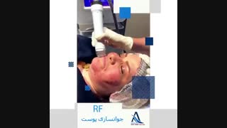 بهترین روش جوانسازی صورت با لیزر آر اف فراکشنال بلیچینگ
