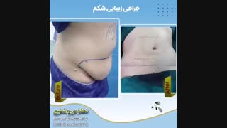 فیلم جراحی زیبایی شکم