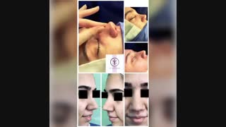 فیلم جراحی زیبایی بینی