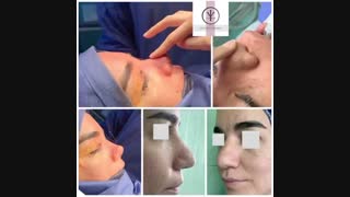 فیلم عمل بینی استخوانی