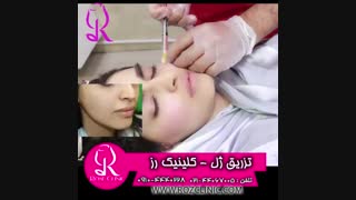 فیلم تزریق ژل | کلینیک رز | 09104440228 | شماره 185