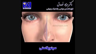 انیمیشن سپتوپلاستی