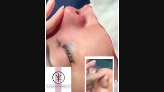 فیلم واقعی جراحی بینی گوشتی