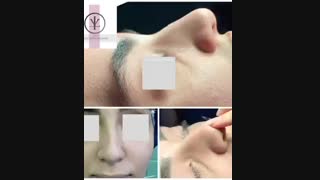 فیلم واقعی جراحی بینی