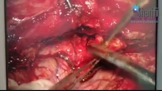 فیلم واقعی جراحی تومور پشت چشم