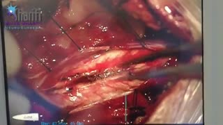 جراحی کیست گردن و وضعیت بیمار بعد از عمل