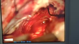 فیلم انتهای عمل جراحی تومور شوانوم گوش