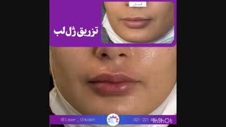 تزریق ژل لب در کلینیک ارکیده