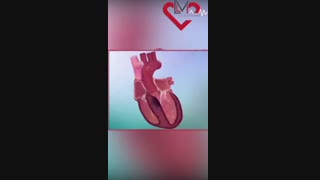 درمان سپتال ابلیشن در مبتلایان به هیپرتروفیک کاردیومیوپاتی