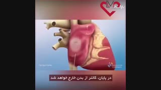 نقص سپتوم بین دهلیزی