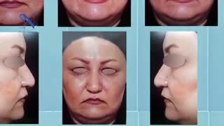 فیلم عمل اصلاح افتادگی پلک بالا