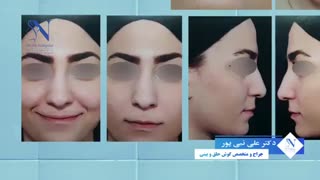 فیلم عمل جراحی بینی