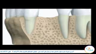 ویدیو بسیار جالب انیمیشن کاشت ایمپلنت دندان