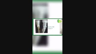 ۹ ماه بعداز  جراحی مجدد زانو بیمار بدون مشکل