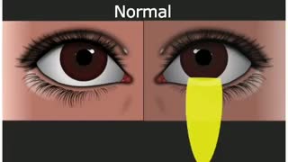 مردمک مارکوس گان