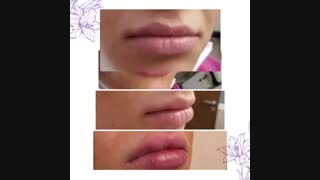 فیلم تزریق ژل لب پاکسازی پوست