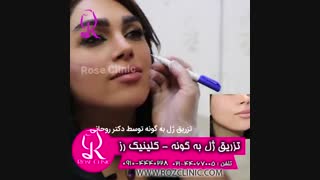 فیلم تزریق ژل | کلینیک رز | 09104440228 | شماره 186