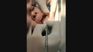 جراحی لثه فک پایین درمان جای جوش