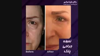 فیلم نمونه جراحی پلک