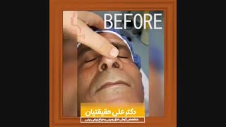 فیلم جراحی زیبایی بینی و انحراف تیغه بینی