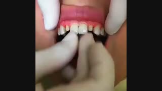 روکش تمام سرامیکی دندان-مرکز فوق تخصصی ایمپلنت پردیس