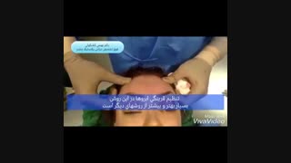 فیلم لیفت آندوسکوپیک ابرو با اندوتاین | پروفسور کشکولی