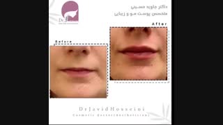 فیلم تزریق فیلر لب