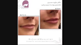 فیلم تزریق ژل لب