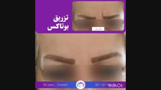 تزریق بوتاکس در کلینیک ارکیده