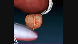 انیمیشن درباره پروستات