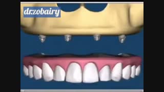 پروتز حفظ شده ایمپلنت!