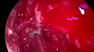 فیلم روش آندوسکوپی پیشرفته برای درمان سینوزیت