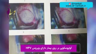 تشخیص HPV با کولپوسکوپی