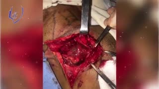 جراحی تومور گردن و  اتصال به عمق پاروتید